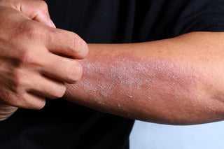 Eczema Awareness Month: Why CLn Body Wash Is a Go-To for Comfortable, Balanced Skin