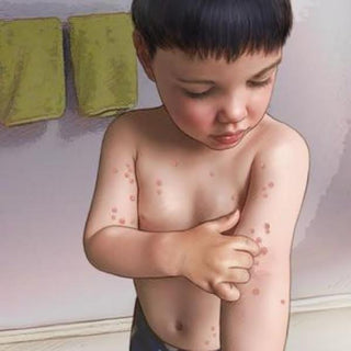 Molluscum Contagiosum: A Guide For Parents