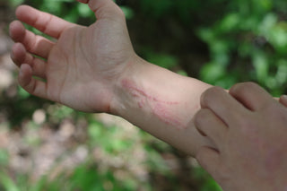 Poison Ivy, Oak, and Sumac: Why Washing Quickly Matters More Than What You Wash With